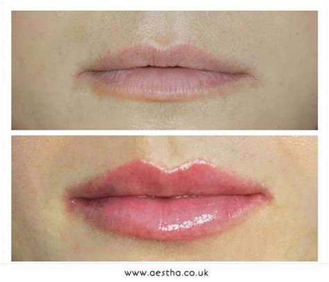 Lip Repair 101: Tips from the Doctor